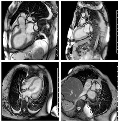 Case Report: Immune Mediated Necrotizing Myopathy With IgG Antibodies to 3-Hydroxy-3-Methylglutaryl-Coenzyme a Reductase (HMGCR) May Present With Acute Systolic Heart Failure